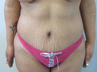 Tummy Tuck Before & After Patient #10740