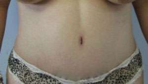 Tummy Tuck Before & After Patient #10743