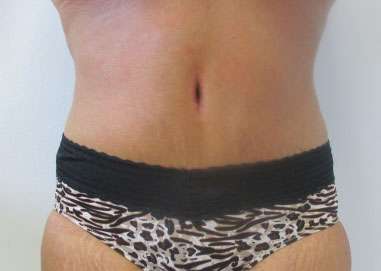 Tummy Tuck Before & After Patient #10746