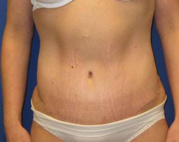 Tummy Tuck Before & After Patient #10755