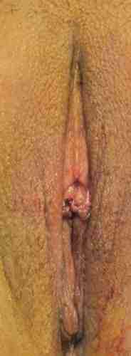 Vaginal Rejuvenation Before & After Patient #10758
