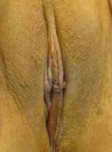 Vaginal Rejuvenation Before & After Patient #10761