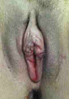 Vaginal Rejuvenation Before & After Patient #10764