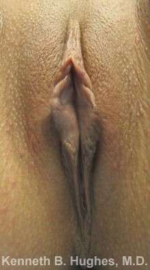 Vaginal Rejuvenation Before & After Patient #10770