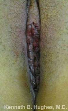 Vaginal Rejuvenation Before & After Patient #10776