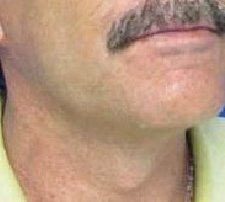 Male Face and Neck Lift Before & After Patient #9709