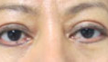 Eyelid Surgery Before & After Patient #8433