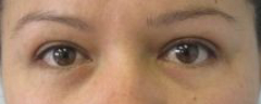 Eyelid Surgery Before & After Patient #8427