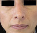 Rhinoplasty Before & After Patient #10313