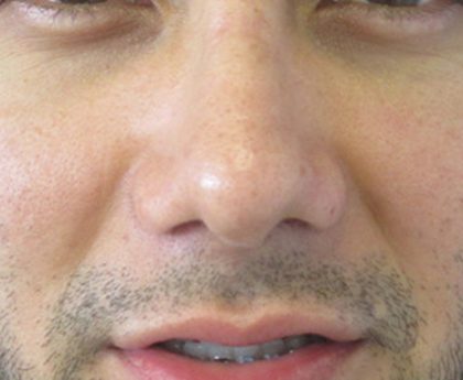 Rhinoplasty Before & After Patient #10293