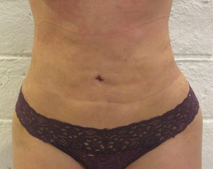 Back Before & After Patient #10988