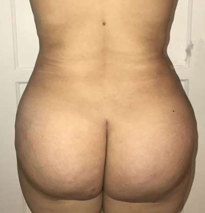 Brazilian Butt Lift Before & After Patient #6455