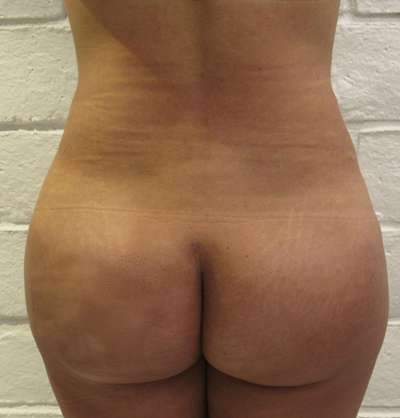 Brazilian Butt Lift Before & After Patient #6470
