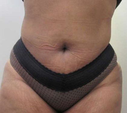 Abdomen Before & After Patient #5892