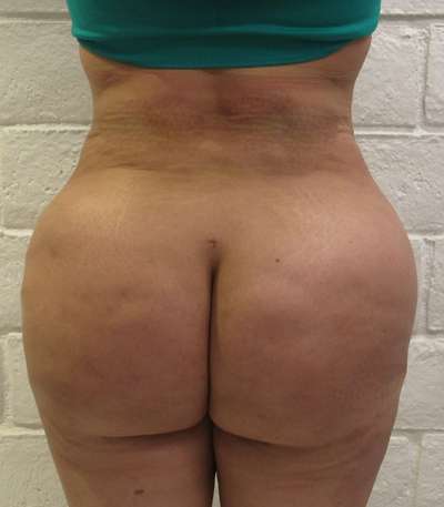 Brazilian Butt Lift Before & After Patient #6506