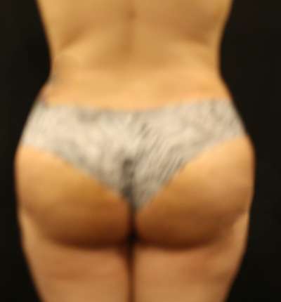 Brazilian Butt Lift Before & After Patient #6517