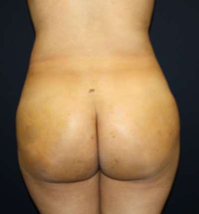 Brazilian Butt Lift Before & After Patient #6524