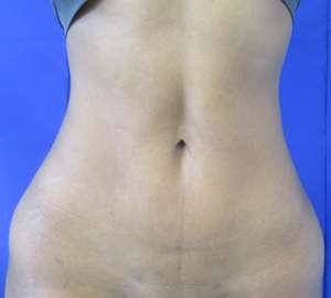 Brazilian Butt Lift Before & After Patient #6548