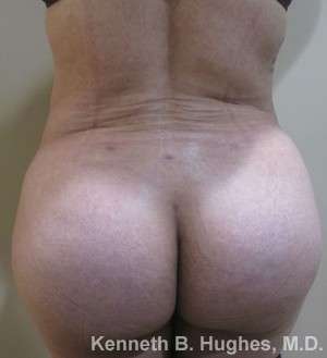 Brazilian Butt Lift Before & After Patient #6567