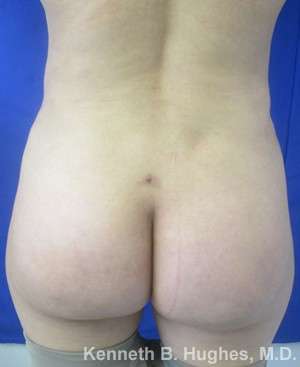 Brazilian Butt Lift Before & After Patient #6575