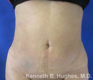 Brazilian Butt Lift Before & After Patient #6582