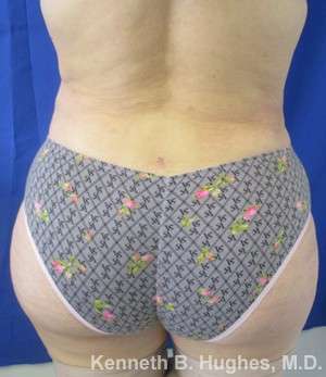 Brazilian Butt Lift Before & After Patient #6596