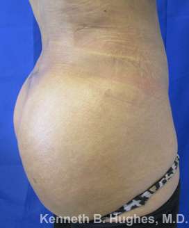 Brazilian Butt Lift Before & After Patient #6599