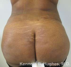 Brazilian Butt Lift Before & After Patient #6605