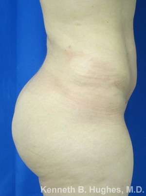 Brazilian Butt Lift Before & After Patient #6611