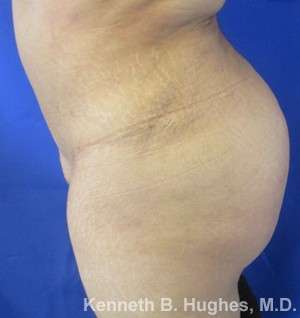 Brazilian Butt Lift Before & After Patient #6616