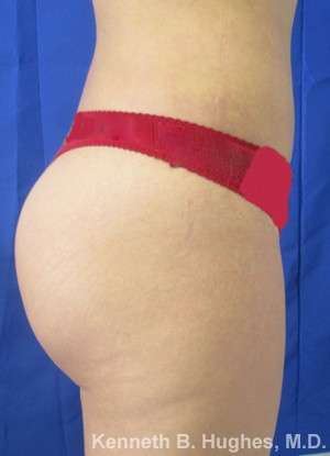 Brazilian Butt Lift Before & After Patient #6624