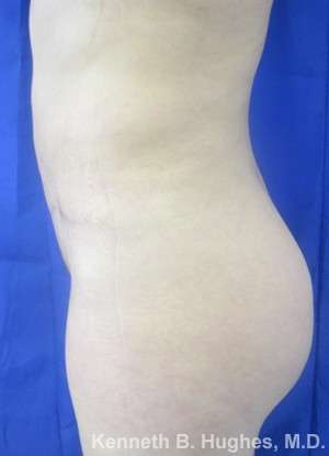 Brazilian Butt Lift Before & After Patient #6627