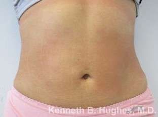 Brazilian Butt Lift Before & After Patient #6637