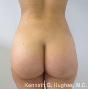 Brazilian Butt Lift Before & After Patient #6640