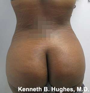 Brazilian Butt Lift Before & After Patient #6647