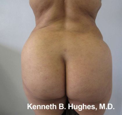 Brazilian Butt Lift Before & After Patient #6655