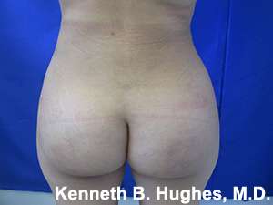 Brazilian Butt Lift Before & After Patient #6660