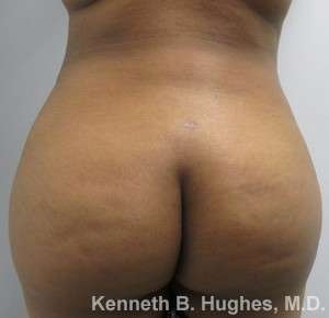 Brazilian Butt Lift Before & After Patient #6668