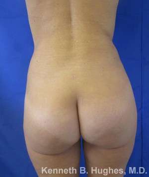 Brazilian Butt Lift Before & After Patient #6676