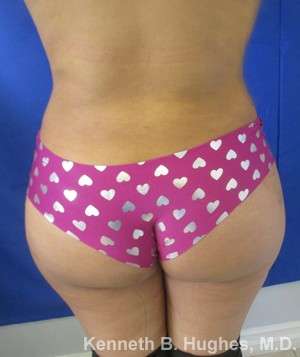 Brazilian Butt Lift Before & After Patient #6691