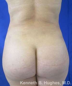 Brazilian Butt Lift Before & After Patient #6702