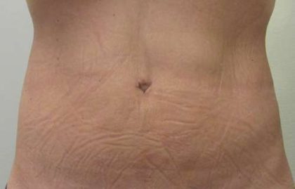 Abdomen Before & After Patient #5913