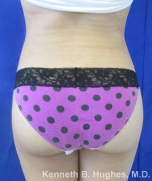 Brazilian Butt Lift Before & After Patient #6723