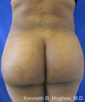 Brazilian Butt Lift Before & After Patient #6728