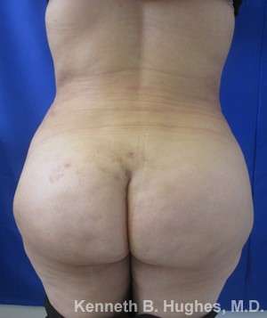 Brazilian Butt Lift Before & After Patient #6733