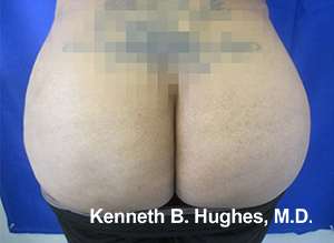 Brazilian Butt Lift Before & After Patient #6749