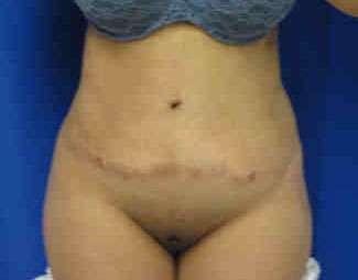 Brazilian Butt Lift Before & After Patient #6752