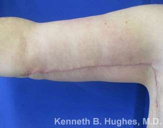 Arm Lift Before & After Patient #5918
