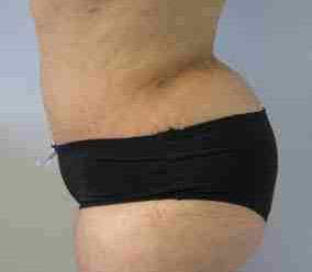 Brazilian Butt Lift Before & After Patient #6763