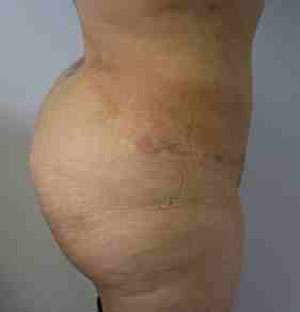 Brazilian Butt Lift Before & After Patient #6769